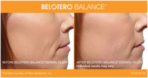 Belotero Balance Before and After Photos | Kay Dermatology in Burbank, CA
