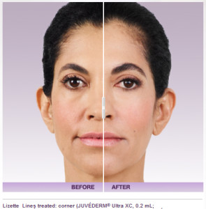 Juvederm Before and After Photos | Kay Dermatology in Burbank, CA