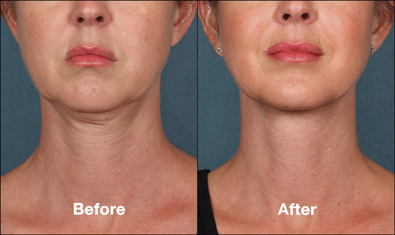 Female Kybella Treatment Before and After Photos | Kay Dermatology in Burbank, CA