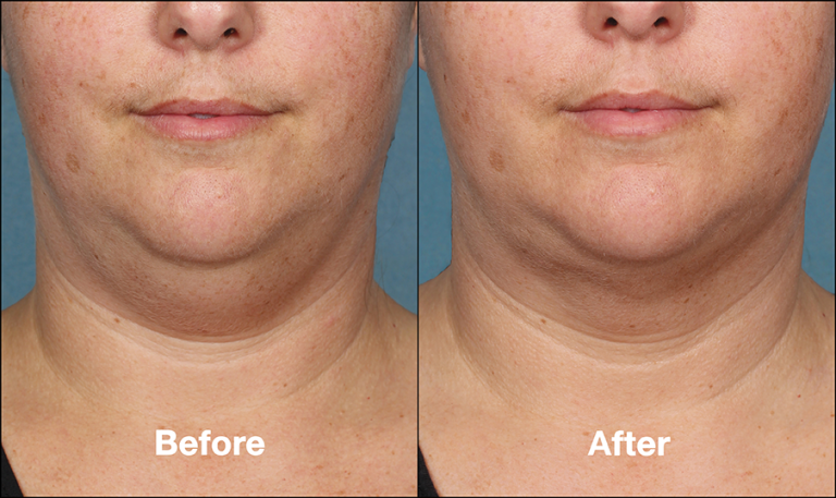 Kybella Treatment Before and After Photos | Kay Dermatology in Burbank, CA