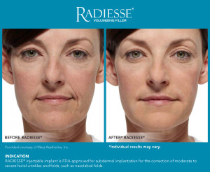 Female Radiesse Before and After Photos | Kay Dermatology in Burbank, CA