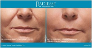 Radiesse Before and After Photos | Kay Dermatology in Burbank, CA