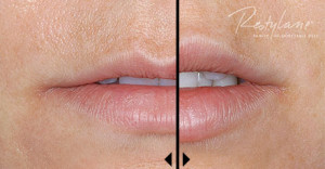 Lip Restylane Treatment Before and After Photos | Kay Dermatology in Burbank, CA