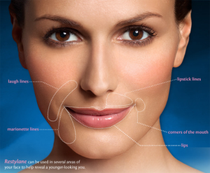 Woman's Face Describing Restylane Treatment Areas | Kay Dermatology in Burbank, CA