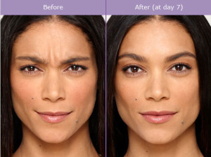 Botox Before and After Photos | Kay Dermatology in Burbank, CA