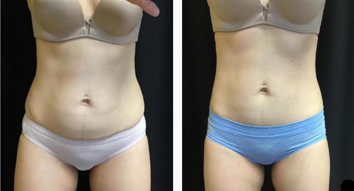 Female Before & After CoolSculpting Treatment Photo | Kay Dermatology in Burbank, CA