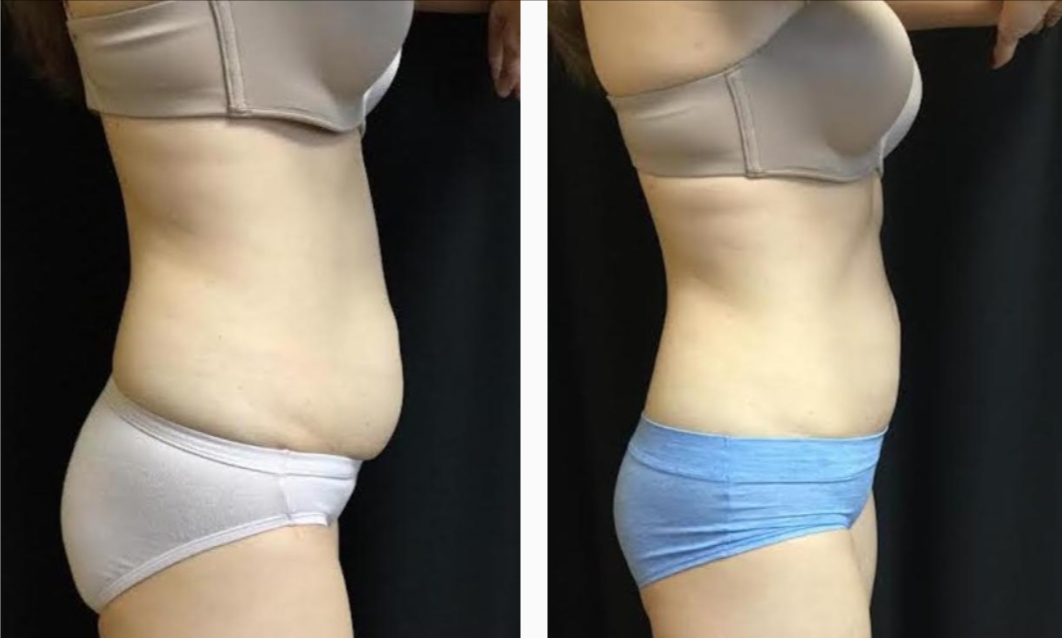Female Before & After CoolSculpting Treatment Photo | Kay Dermatology in Burbank, CA