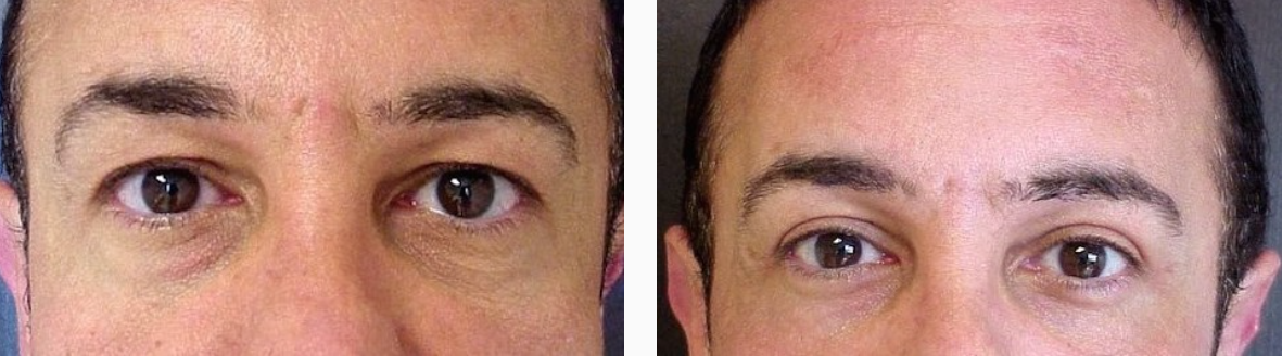 Male Before & After Eyelid Surgery Photo | Kay Dermatology in Burbank, CA