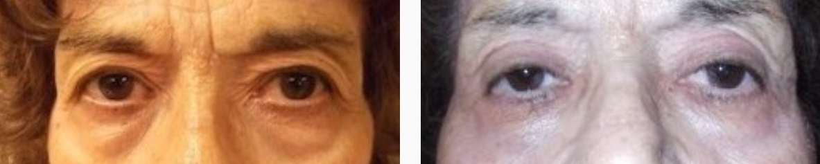 Before & After Eyelid Surgery Photo | Kay Dermatology in Burbank, CA