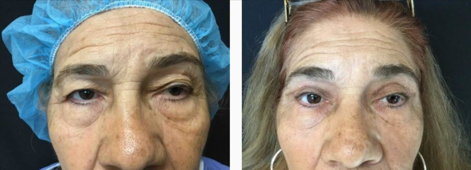 Female Before & After Eyelid Surgery Photo | Kay Dermatology in Burbank, CA