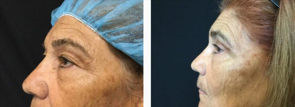 Female Before & After Eyelid Surgery Photo | Kay Dermatology in Burbank, CA