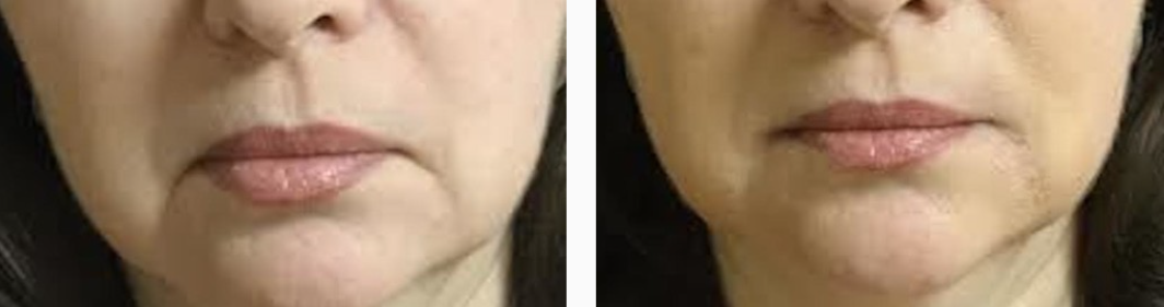 Young Female Before & After Injectable Filler Treatment Photo | Kay Dermatology in Burbank, CA