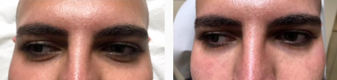 Young Female Before & After Injectable Filler Treatment Photo | Kay Dermatology in Burbank, CA