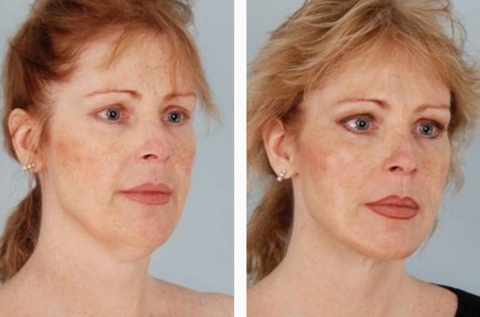 Female Before & After Liposuction Treatment Photo | Kay Dermatology in Burbank, CA