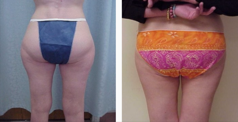 Before & After Liposuction Treatment results | Kay Dermatology in Burbank, CA