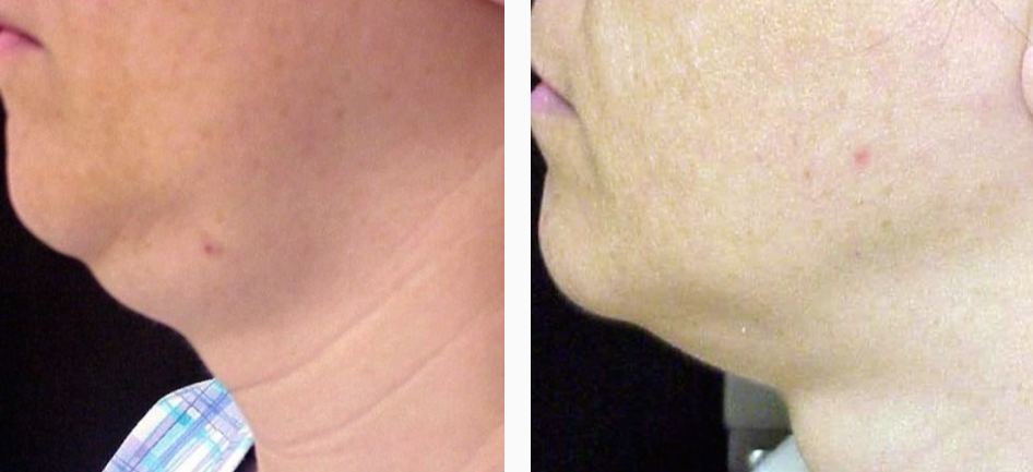 Before & After Liposuction Treatment results face | Kay Dermatology in Burbank, CA