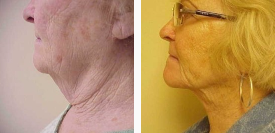 Before & After Neck lift Treatment results | Kay Dermatology in Burbank, CA