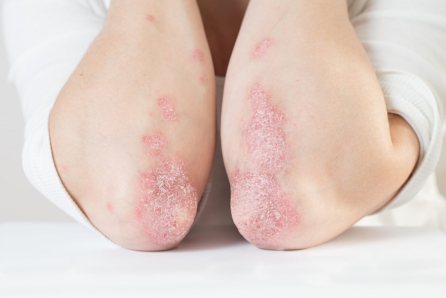 Acute psoriasis on the elbows is an autoimmune incurable dermatological skin disease. Large red, inflamed, flaky rash on the knees. Joints affected by psoriatic arthritis | Kay Dermatology in Burbank, CA