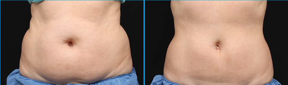 Before & After CoolSculpting Treatment Photo | Kay Dermatology in Burbank, CA