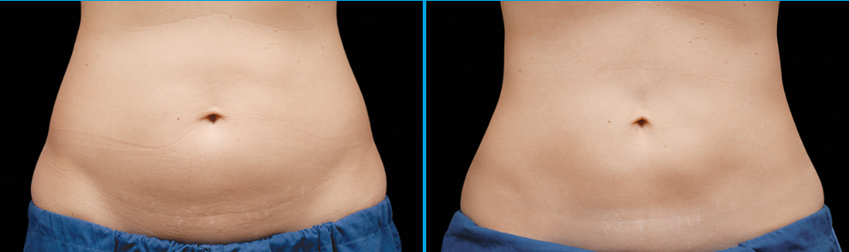 Before & After CoolSculpting Treatment Photo | Kay Dermatology in Burbank, CA