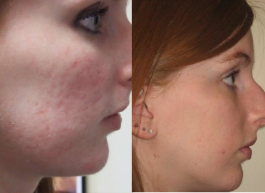 Before & After Laser Skin Resurfacing Treatment results of a female | Kay Dermatology in Burbank, CA