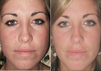 Female Before & After Laser Skin Resurfacing Treatment - Case Five Photo | Kay Dermatology in Burbank, CA