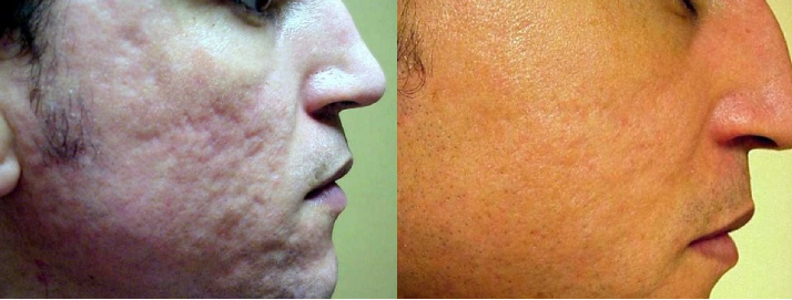 Male Before & After Laser Skin Resurfacing Treatment - Case one Photo | Kay Dermatology in Burbank, CA