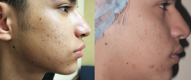 Young man Before & After Laser Skin Resurfacing Treatment - Case Six Photo | Kay Dermatology in Burbank, CA