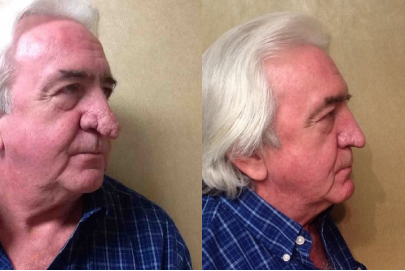 Male Before & After Laser Skin Resurfacing Treatment - Case Three Photo | Kay Dermatology in Burbank, CA