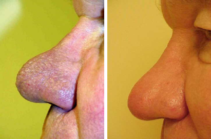 Male Before & After Laser Skin Resurfacing Treatment - Case Two Photo | Kay Dermatology in Burbank, CA