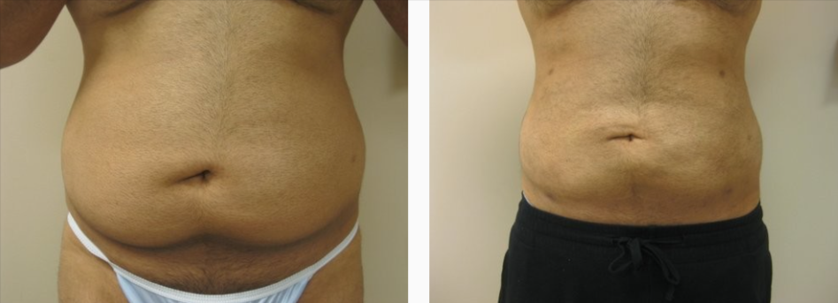 Before & After Liposuction Treatment results of a male | Kay Dermatology in Burbank, CA