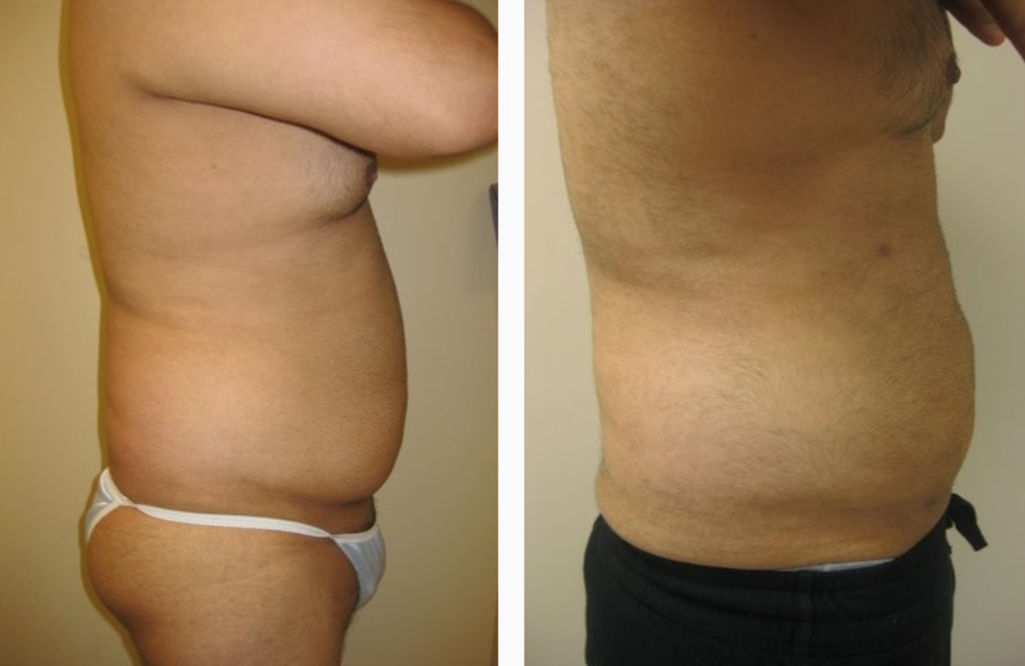 Before & After Liposuction Treatment results of a male | Kay Dermatology in Burbank, CA