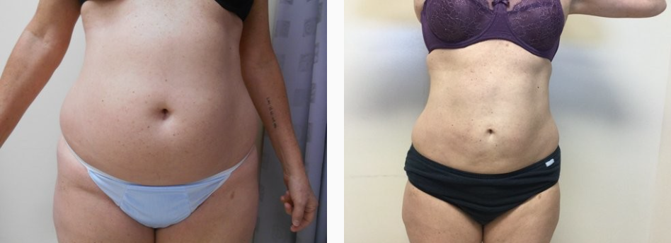 Before & After Liposuction Treatment results of a female | Kay Dermatology in Burbank, CA