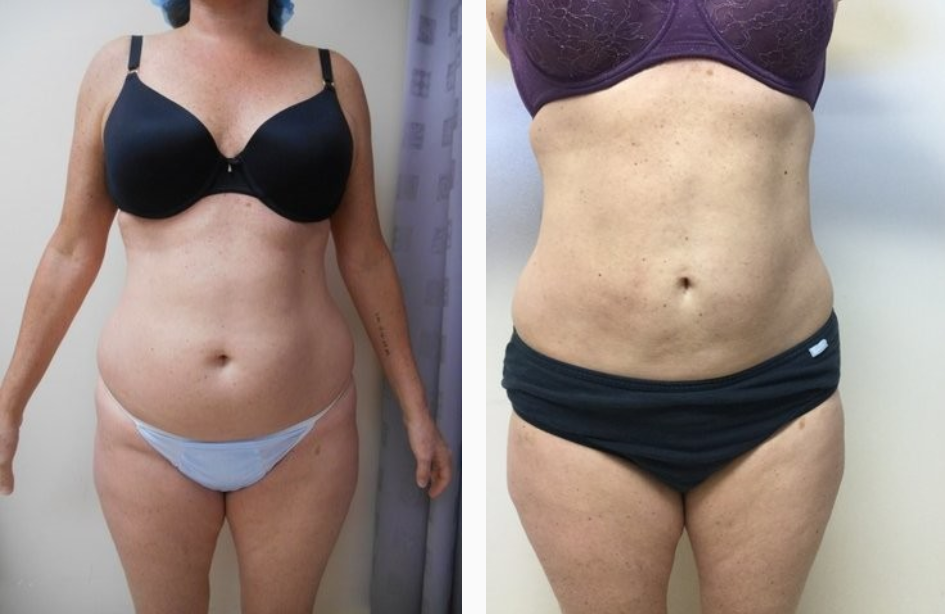 Before & After Liposuction Treatment results of a female | Kay Dermatology in Burbank, CA