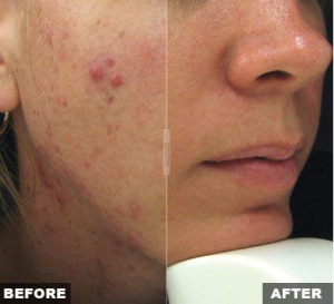 Fraxel Laser Before and After Photos | Kay Dermatology in Burbank, CA