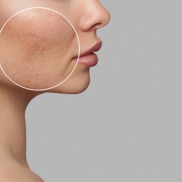 Acne Scars Treatment | Kay Dermatology in Burbank, CA