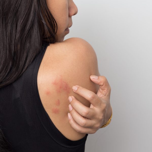 woman showing her skin itching behind , with allergy rash urticaria symptoms | Kay Dermatology in Burbank, CA