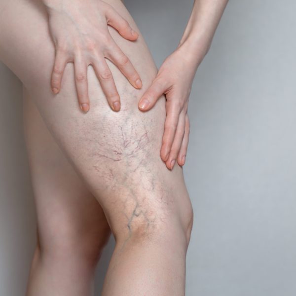 kaydermatology services sclerotherapy in burbank ca