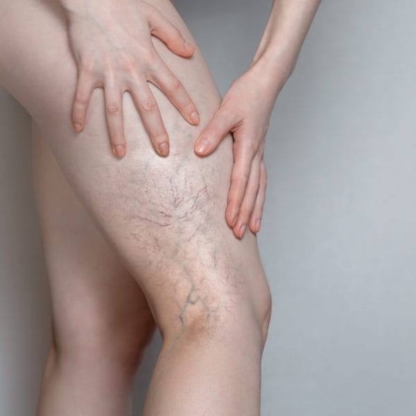 Sclerotherapy for Varicose Veins - Vein & Endovascular Medical Care