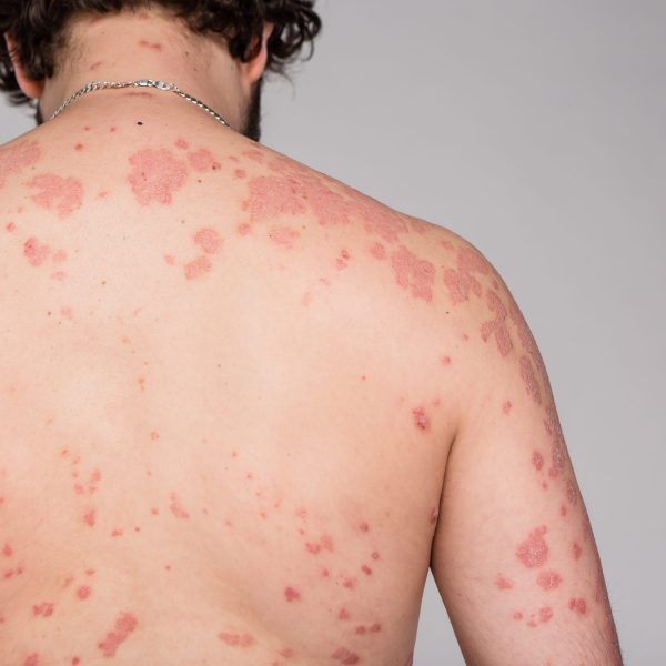 Psoriasis skin. Psoriasis is an autoimmune disease that affects the skin cause skin inflammation red and scaly | Kay Dermatology in Burbank, CA
