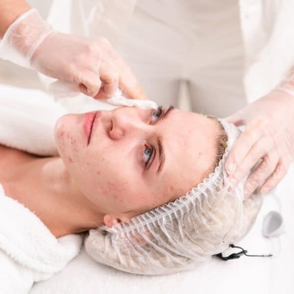 Acne Treatment | Kay Dermatology in Burbank, CA