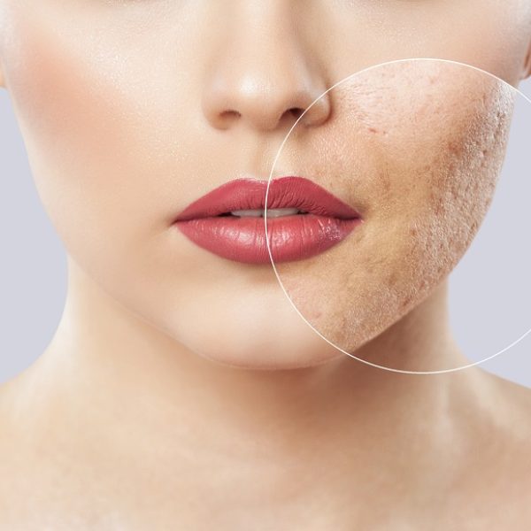 kaydermatology services acne scar treatments in burbank ca