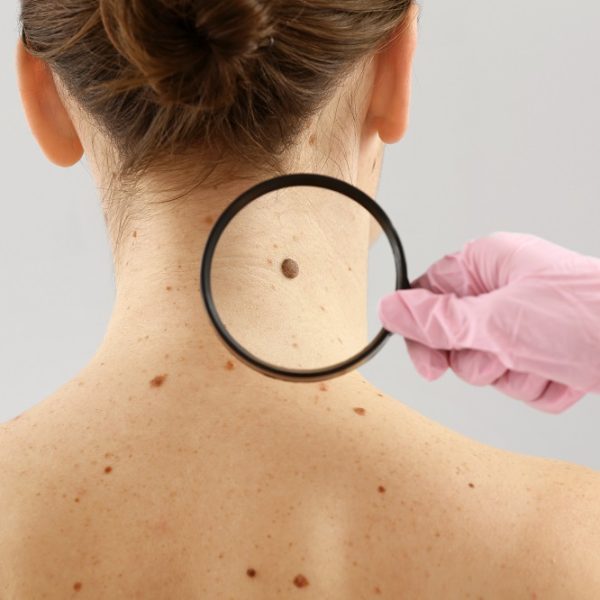 dermatologist examines birthmarks on the patient's skin with a dermatoscope. Dermatology, skin mole exam | Kay Dermatology in Burbank, CA