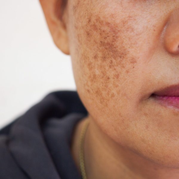 Pigmented spots on the face. Pigmentation on cheeks | Kay Dermatology in Burbank, CA
