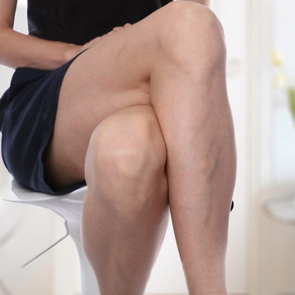 Varicose veins on woman legs | Kay Dermatology in Burbank, CA