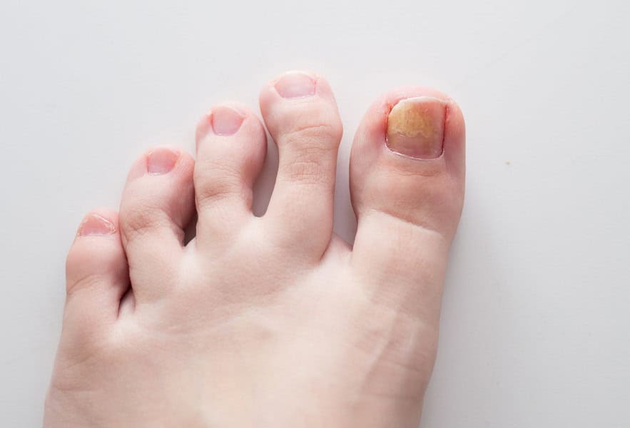 Fungus on the nail. Fungal disease on the toe. Medicine, treatment | Kay Dermatology in Burbank, CA