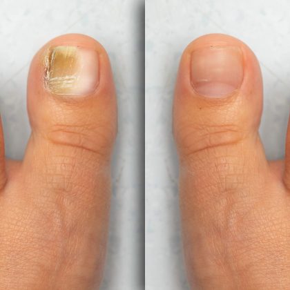 Before and After Fungus on the nail. Fungal disease on the toe. Medicine, treatment | Kay Dermatology in Burbank, CA