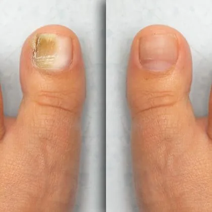 Dermoscopic Evaluation of Inflammatory Nail Disorders and Their Mimics |  HTML | Acta Dermato-Venereologica