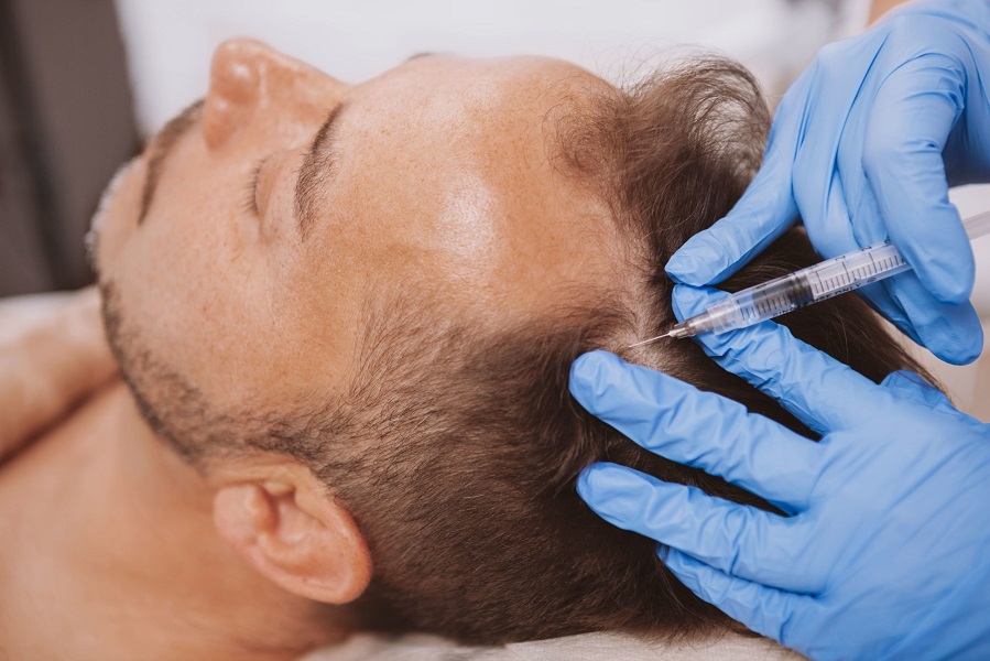 Young Male Head during Hair Restoration treatment injection | Kay Dermatology in Burbank, CA