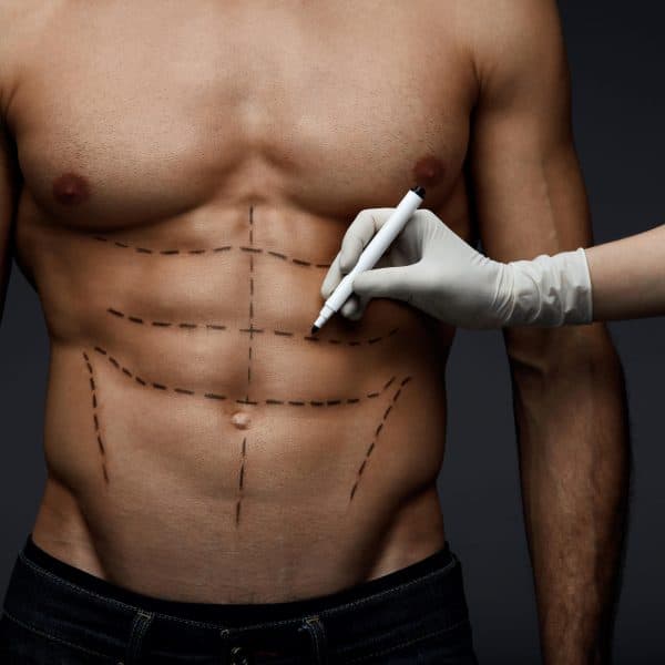 Male Body With Lines Before Beauty Operation. Plastic Surgery | Kay Dermatology in Burbank, CA